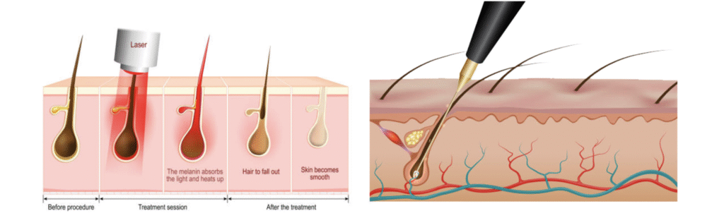 electrolysis v laser hair removal